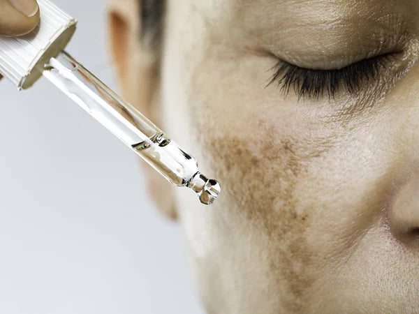5 Steps To Get Rid of Sunburn Redness Overnight